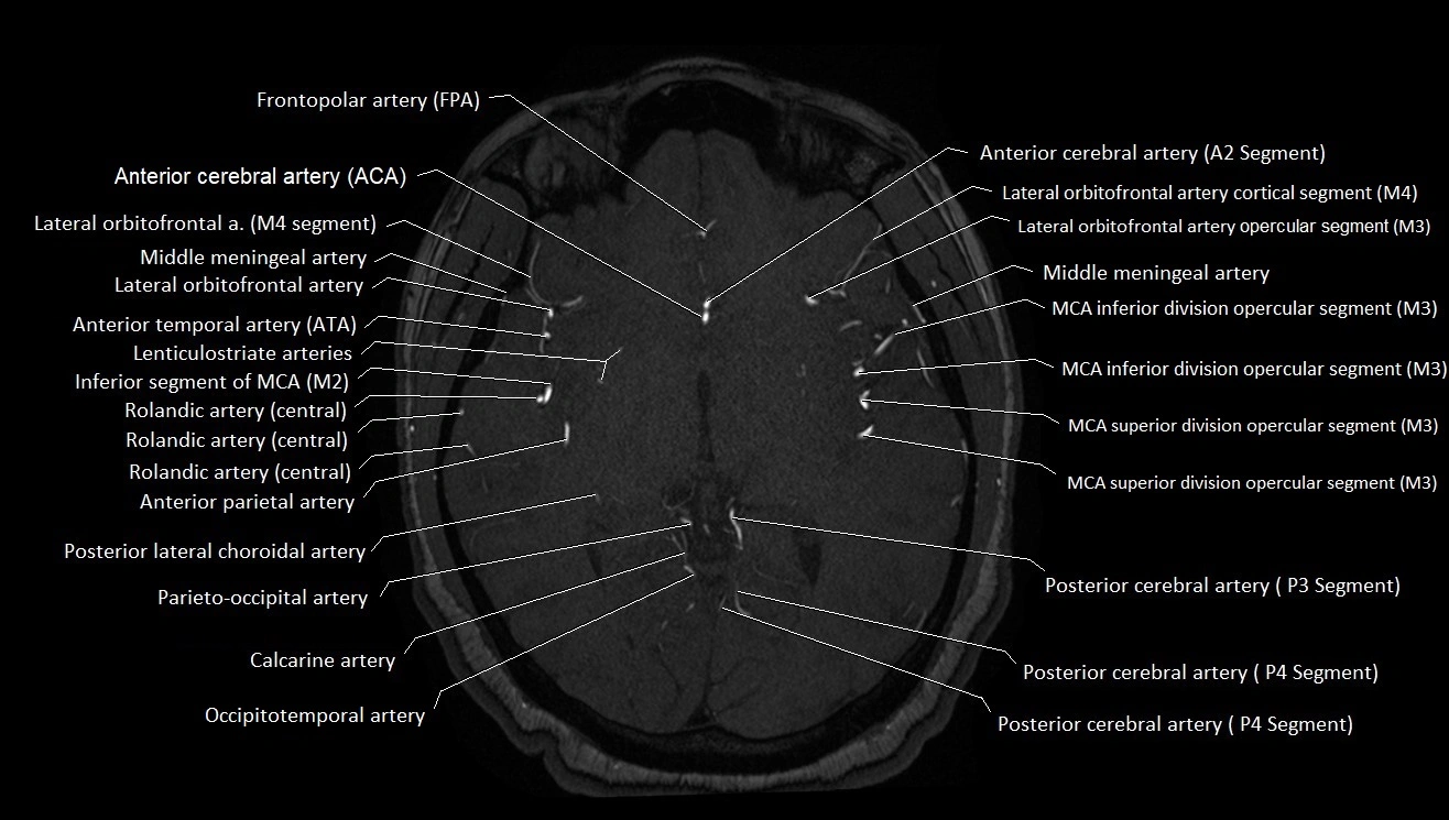 MRA brain (cerebral arteries) anatomy axial 3T image 25.webp